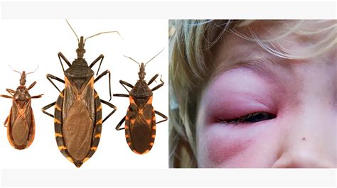 Understanding Bug Bites Types Symptoms And Treatment