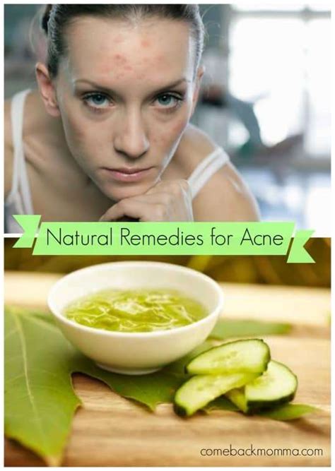 Natural Remedies For Acne Comeback Momma