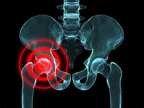 The Difference Between Tendonitis And Osteoarthritis Of The Hip Ace