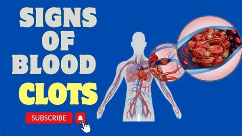 Top Warning Signs Of Blood Clots Be Careful Youtube