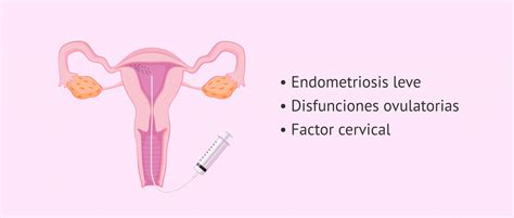 T Cnicas De Reproducci N Asistida Para Combatir La Infertilidad Femenina
