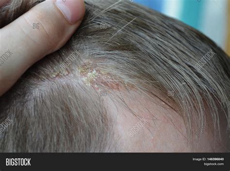Psoriasis On Hairline On Scalp Image And Photo Bigstock