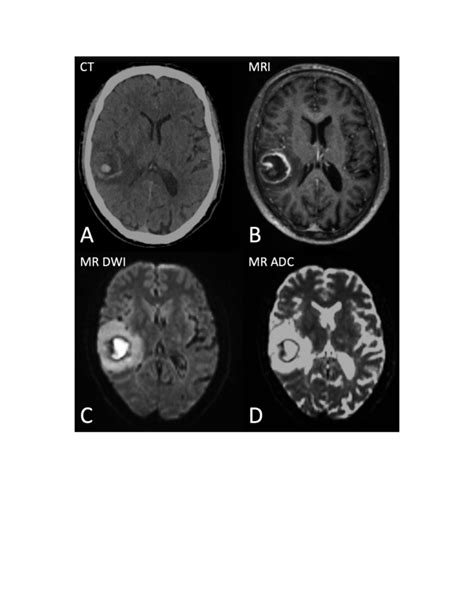 A Contrast Enhanced Computed Tomography Ct Scan And B