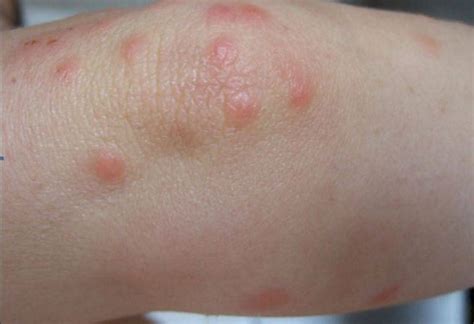 Itchy Red Bumps On Elbows