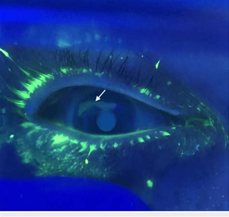 Fluorescein Staining Of The Eye Revealing A Large Corneal Abrasion At