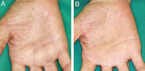 A Palmoplantar Pustulosis Appeared Before Tonsillectomy B The