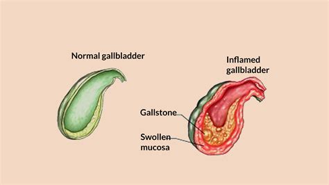 Cholecystitis Diagnosis Treatment And Prevention