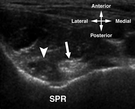 The Snapping Iliopsoas Tendon New Mechanisms Using Dynamic Sonography