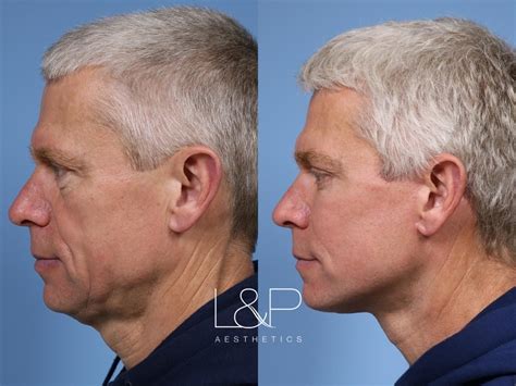Male Facelift And Neck Lift At Landp Aesthetics