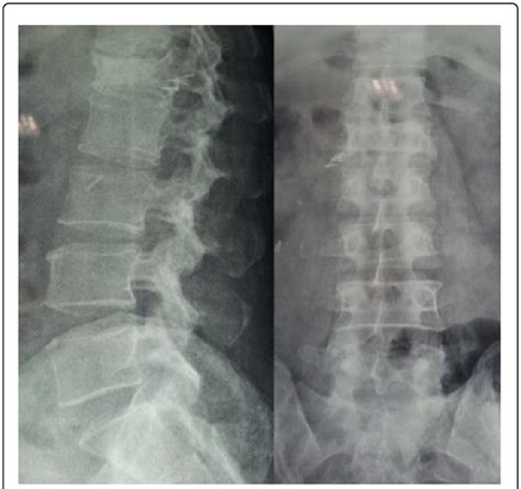 Anteroposterior And Lateral Radiographs Of The Dorsolumbar Spine