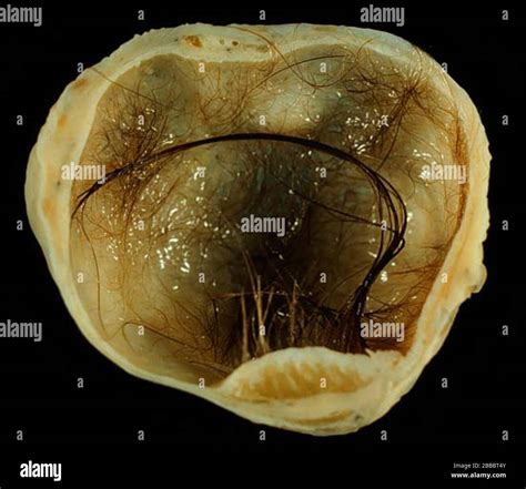 Teratoma de ovario maduro fotografías e imágenes de alta resolución Alamy