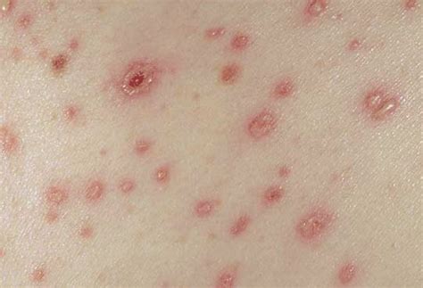 Maculopapular Rash Pictures Causes Symptoms Treatment