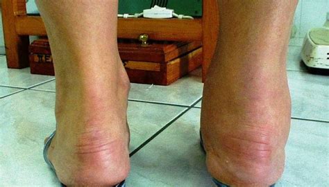 Rheumatoid Arthritis In The Ankles Symptoms And Treatment