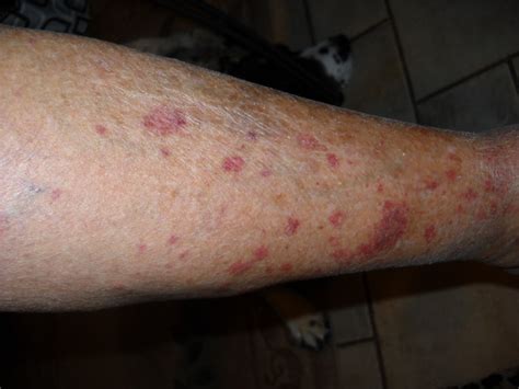 Red Blotches On Legs What Is Blood Glucose