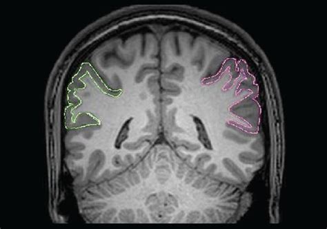 Tracing Of The Inferior Parietal Lobule Right Side In Pink Color And