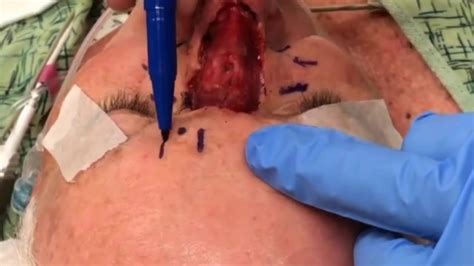 Paramedian Forehead Flap Technique With Dr Saigal YouTube