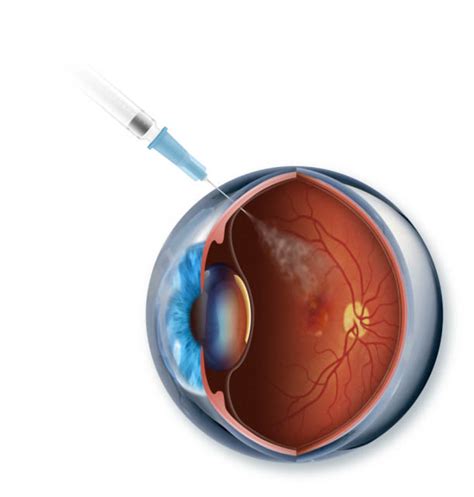 Eylea And Lucentis Injections For Treatment Of Retinal Diseases Khmer