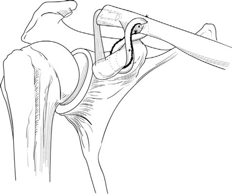 Biomechanics And Treatment Of Acromioclavicular And Sternoclavicular