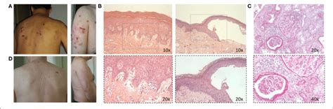 A Active Bullous Pemphigoid Skin Lesions B Histological Images