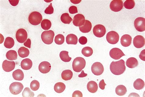 Complement C1s Inhibition May Prevent Hemolysis In Cold