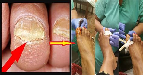 Toenail Fungal Infections May Lead To Widespread Infection And Even