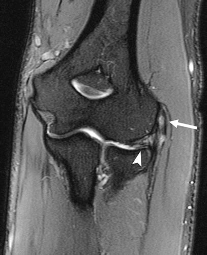 Elbow Imaging In Sport Sports Imaging Series Radiology