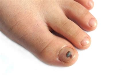 What Does It Mean When Your Toenail Turns Black Toenail Turning