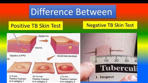 Difference Between Positive TB Skin Test And Negative TB Skin Test