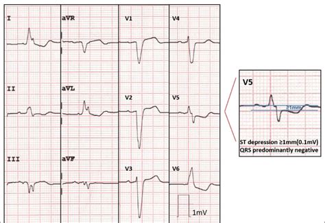 Ecg From A Patient With Acute Myocardial Infarction And Culprit Lesion
