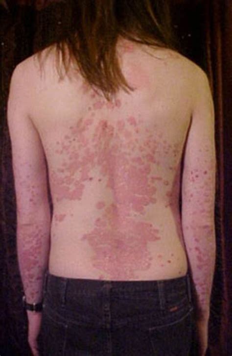 Biologics New Treatment Hope For Psoriasis Sufferers Prescription