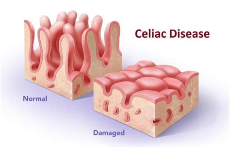 Here Are 5 Complications Of Celiac Disease You Should Be Aware Of