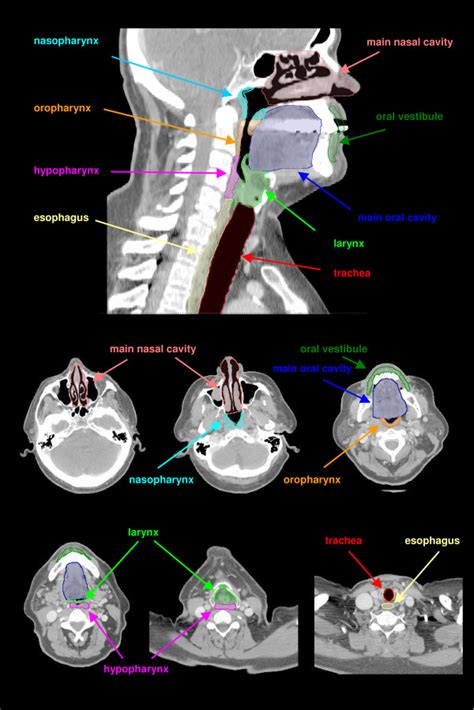 Anatomic Head And Neck Regions Contoured On A Sagittal Drr And