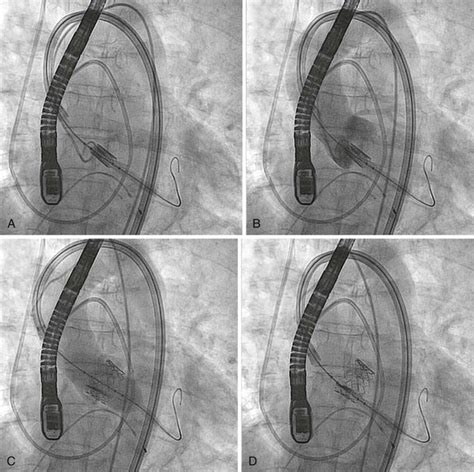 Imaging Guidance Of Transcatheter Valve Procedures Thoracic Key