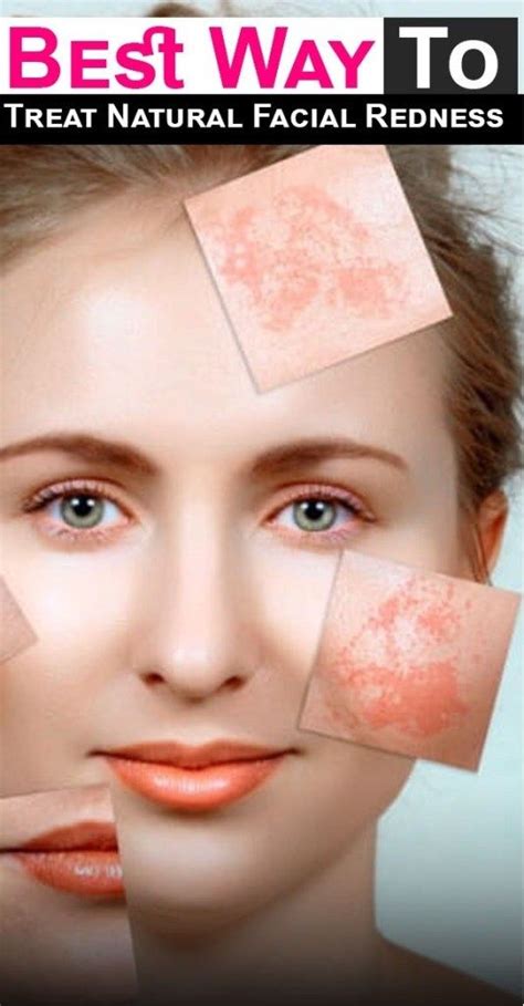 how to treat natural facial redness with images natural facial redness facial
