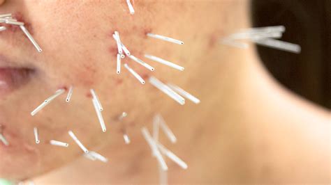 Acupuncture For Acne Treat Your Skin With This Ancient Treatment