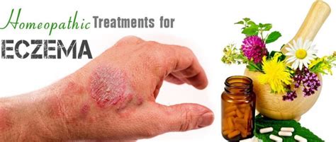 Best 5 Homeopathic Treatments For Eczema That Work Biophytopharm