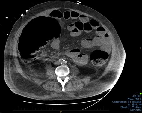 Figure 1 From A Rare Case Report Of Ascending Colon Perforation