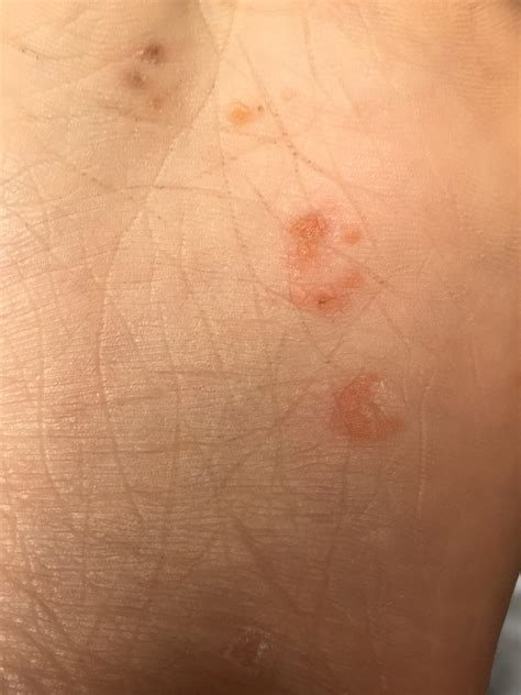 These Spots Appeared On The Bottom Of My Left Foot I Dont Feel Any