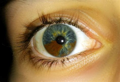 In Sectoral Heterochromia One Part Of The Eye Is Different From Its