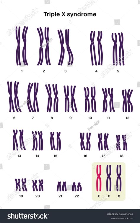 Human Karyotype Triple X Syndrome Female 库存矢量图（免版税）2040430007 Shutterstock