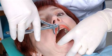Broken Tooth Extraction Procedure Archives Elite Dental Care
