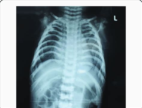 Radiograph Of Chest Showing Diffuse Sclerosis Of Ribs D Fundus