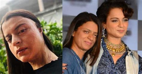 Chhapaak In Kangana Ranauts Sisters Life Rangoli Shares Acid
