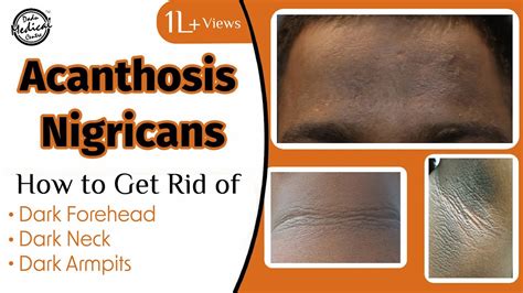 Acanthosis Nigricans How To Get Rid Of Dark Neck And Armpits Dr