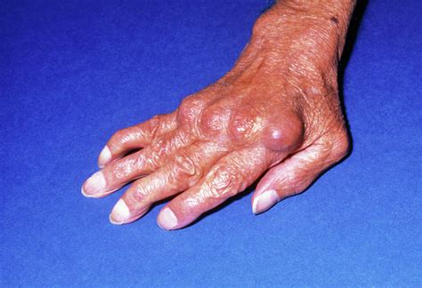 Deformation Of Hand Due To Rheumatoid Arthritis Photograph By James
