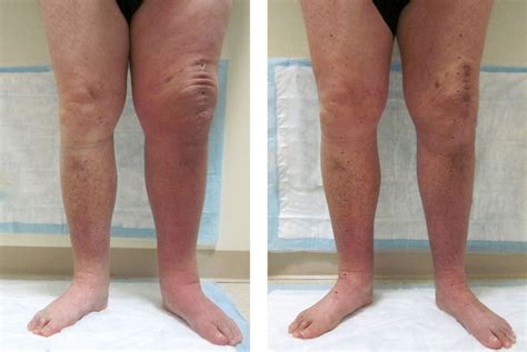 Before And After Results Lymphedema And Wound Care Consultants