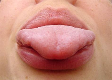 Oral Herpes Tongue The Image Kid Has It