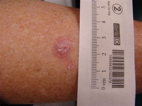Photos Of Skin Cancer On Leg