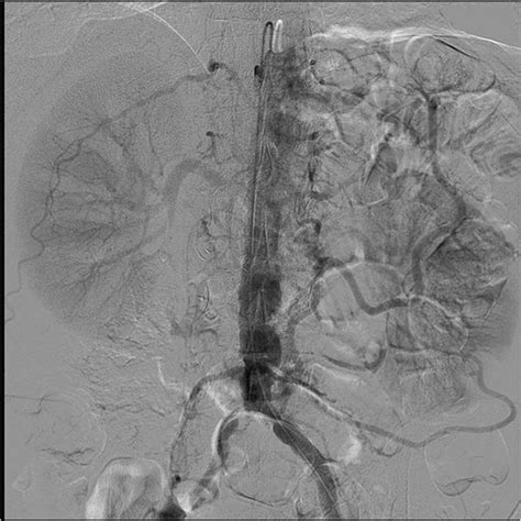 Mesenteric Angiogram Both The Celiac And Superior Mesenteric Arteries