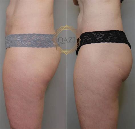 Why A Non Surgical Butt Lift Is So Popular In Orange County Ca
